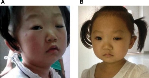 Figure 1 Phenotypical characteristics of the proband before (A) and after (B) blepharoplasty.