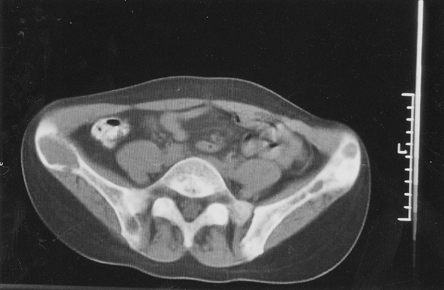 Figure 4. Multiple expansive cyst-like lesions of both iliac wings with bone sclerosis of the left iliac wing.