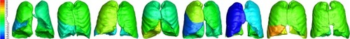 Figure 2 Variability in changes from exacerbation to stable state in iVlobe at TLC in individual patients (8 patients randomly selected). The scale represents the percent change in the volume of the different lung lobes at TLC; red represents an increase in volume, while blue represents a decrease.Abbreviations: iVlobe, lobar volume measured by FRI; TLC, total lung capacity.