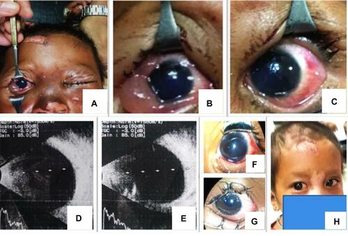 Figure 1 (A) A child patient with resultant burn secondary to lightning strike. (B, C) Conjunctival congestion and chemosis with corneal edema. Lens was cataractous. (D, E) Normal posterior segment findings in B-scan. (F, G) Post-operative findings in both eye after lens aspiration and posterior chamber intraocular lens implantation. (H) Healing of the burn scars after 3 weeks.