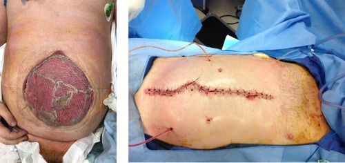 Figure 5 Clinical images of a patient subjected to split-thickness skin graft as a temporary abdominal closure after achieving successful treatment of enteroatmospheric fistulas, and to definitive fascial closure after 3 months. 