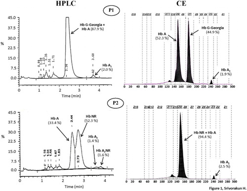 Figure 1. Hemoglobin analysis of the two patients (P1 and P2) who were respectively compound heterozygotes for Hb G-Georgia/α0-thalassemia and Hb Nakhon Ratchasima/α0-thalassemia using automated HPLC and CE systems. The separated profiles of Hb G-Georgia, Hb Nakhon Ratchasima (NR), Hb A, Hb A2 and Hb A2NR are depicted.
