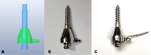 Figure 4 Bushing and miniscrew utilized for lateral positioning between second premolar and first molar. (A) Virtual model. (B) Physical bushing produced with selective laser melting technology and conventional prefabricated miniscrew. (C) 0.010 steel ligature tie between head of miniscrew and bushing pin. Adapted with permission from Cantarella D, Quinzi V, Karanxha L, Zanata P, Savio G, Del Fabbro M. Digital workflow for 3D design and additive manufacturing of a new miniscrew-supported appliance for orthodontic tooth movement. Appl Sci. 2021;11.Citation20