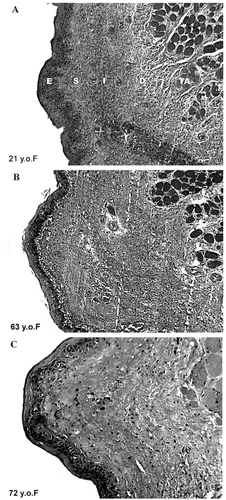 Figure 4 Coronal sections of the vocal fold from 21years old (A), 63 years old (B) and 72years old (C) females illustrating age related changes in the epithelium and lamina propria. Safran-Hematoxylin Stain, 20x original magnification. E – epithelium, S – superficial layer of the lamina propria, I – intermediate layer of the lamina propria, D – deep laryner of the lamina propria. Portions of the adjacent thyroarytenoid muscle (TA), which form a part of the body of the vocal fold, are also illustrated.