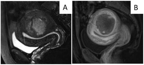 Figure 6. MRI obtained from a 46-year-old patient who did not report abnormal vaginal bleeding. A. T2WI of MRI showed a hyperintense mass with an irregular margin. B. Contrast enhanced MRI showed no enhancement in the center of the lesion. According to the nomogram chart, the patient scored 0 points for no abnormal vaginal bleeding, 90 points for unclear margin of the lesion, 93 points for hyperintensity on T2WI, 100 points for no enhancement in the central area. The total score for this patient was 283 points. The diagnosis of uterine sarcoma was confirmed after surgery.