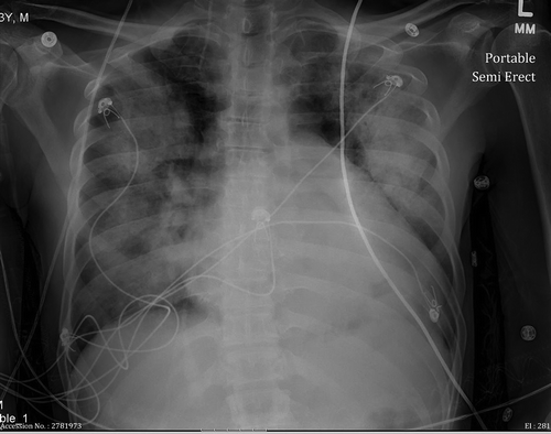 Figure 1. CXR showed cardiomegaly and bilateral infiltrates