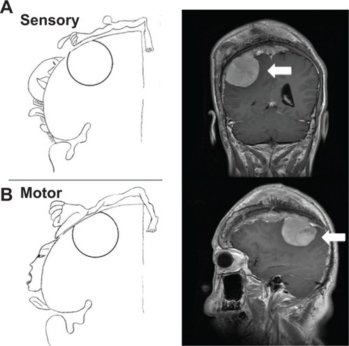 Figure 5 Depending on the location of the patient’s meningioma (arrows), the weakness, numbness, and paresthesia of the upper-left limb were compatible with the cortical homunculus, which compressed to the primary somatosensory area (A) and the primary motor cortex (B).