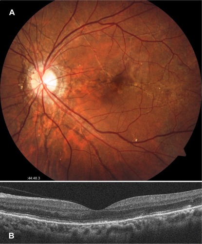 Figure 4 Left fundus findings 2 months after the intravitreal injection of bevacizumab.