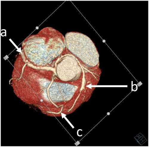Figure 1. Cardiac computed tomography angiography image showing dominant right coronary artery (a) and its two branches: the first vessel (b), the second one (c).