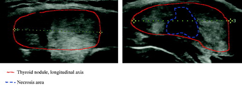 Figure 1. Longitudinal scan of toxic nodule before (AP 23 mm × TR 32.5 × LG 39 mm; volume 15.2 ml) and after 6 months (AP 15 mm × TR 22.5 mm × LG 29; volume 5.1 ml) of single session of LA.