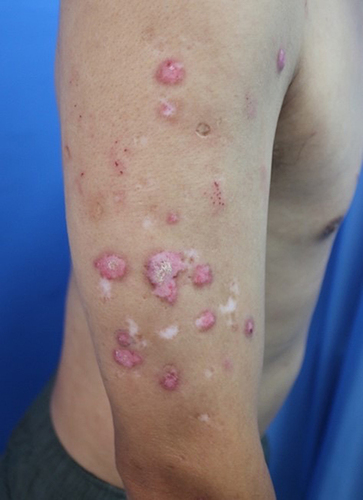 Figure 1 The initial lesions on the right arm, showing well-demarcated erythematous plaques and white macules at the first visit in 2022.