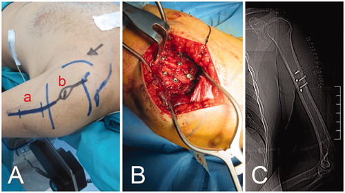 Figure 2. (A) The first incision (a) is performed on the same line as the incision necessary for tumor removal (b), as close as possible to the tumor, with a wide margin; (B) an intraoperative view of the five screws inserted in the bone as fiducial landmarks; (C) the scout-view showing the landmark screws.