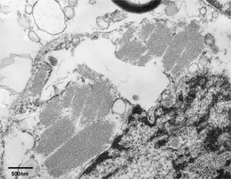 Figure 5 Crystalline inclusions show regular periodicity and none of them are membrane bound, × 15,000.