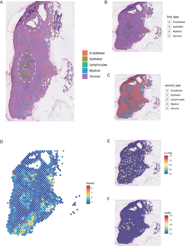 Figure 3 Ecological niche of cell subpopulations was localized by spatial transcriptome in EM (A) After RCTD processing, the estimated cell proportion in each spot representing 1–10 cells was mapped to the image. (B) and (C) were respectively the spatial distribution of the cell type of the first and the second for each spot. (D) Spot map of the tissue spatial distribution of myeloid cells. Their heatmaps were respectively normalized using normalization. (E) and (F) were the spatial distribution of IL17RA and RORC expression.