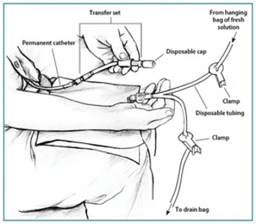 Figure 2. Diagram illustrating the technique for exchange of fluid during peritoneal dialysis. Used with permission from National Institute of Diabetes and Digestive and Kidney Diseases, National Institutes of Health.