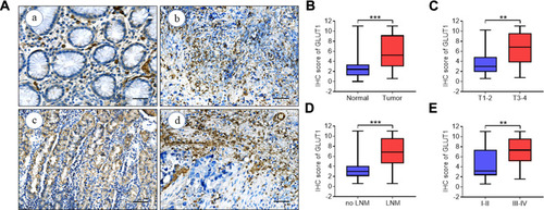 Figure 1 GLUT1 expression in GC tissues. (A) Representative immunohistochemistry (IHC) staining of GLUT1 in GC and adjacent normal tissues (scale bar = 100μm, (a) negative (b) weak (c) positive (d) strongly positive). (B-E) Nonparametric t test of IHC scores between (B) normal and tumor tissues, (C) T1-2 and T3-4, (D) no LNM and LNM and (E) TNM I-IIand TNM III-Ⅳ (**P<0.01; ***P<0.001).Abbreviations: T, tumor grading; LNM, lymph node metastasis; TNM, TNM staging.