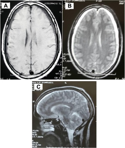 Figure 1 A and B: Axial cerebral MRI in T1 and T2 weighted views, without contrast injection, showing bilateral subdural fluid collection and engorgement of superior sagittal sinus. C: Sagittal T2 weighted views, showing obliteration of prepontine cistern.