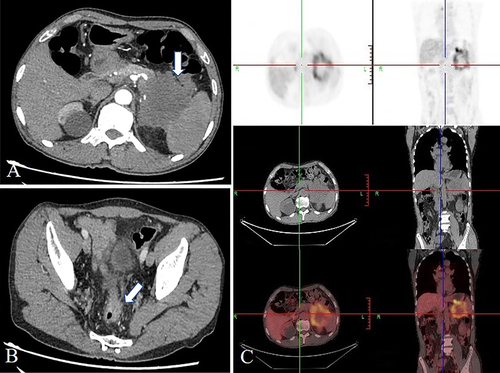 Figure 2 (A) Contrast-enhanced CT showed a mass, 69*72mm in the tail of pancreas (White arrow). (B) Contrast-enhanced CT showed the thickening of the sigmoid colon (White arrow). (C) 18-FDG PET-scan showed a pancreatic metabolic lesion compatible with neoplastic mass.