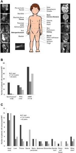 Figure 1 Localization of extracranial MRT (EU-RHAB registry data). (A) Anatomical localization of patients with extracranial MRT (n=185) registered between 2007 and 2020. The most common localizations of primary tumors are highlighted bold. (B) Distribution of patients with extracranial MRT (n=185) by age and localization registered between 2004 and 2020. * Patients with ATRT and RTK or eMRT. (C) Distribution of patients with eMRT (n=118) by age and primary site registered between 2004 and 2020. *Other sites: bladder (n=2), heart (n=1), skin (n=2), pancreas (n=1), adrenal gland (n=1), clavicle (n=1), brachial plexus (n=1).