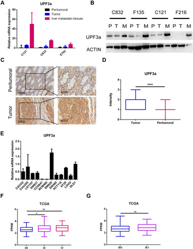 Figure 1 UPF3a was overexpressed in CRC cells and tumor tissues. (A) UPF3a mRNA was detected with real-time quantitative polymerase chain reaction test in tumor tissues, paired peritumoral tissues and distant liver metastatic tissues, respectively. C121, C633 and E702 means the serial number of the patients tissues. (B) Western blotting assay was used to detect UPF3a protein expression in tumor tissues (T), paired peritumoral tissues (P) and distant liver metastatic tissues (M), respectively. C832, F135, C121 and F216 means the serial number of the patients tissues. (C) Immunohistochemistry (IHC) assay showed UPF3a protein expression in tumor tissues compared with paired peritumoral tissues. Magnification: ×200, left panels; ×400, right panels. (D) Statistical analysis showed significant disparity of UPF3a expression between tumor tissues and paired peritumoral tissues. ***Means p<0.001. (E) UPF3a mRNA was detected by real-time quantitative polymerase chain reaction test in 10 CRC cells and 2 normal epithelial cells (CCD841 and NCM460), respectively. (F) TCGA data showed UPF3a expression level in different stages (I/II,III and IV) of CRC tumor tissues. *Means p<0.05, **means p <0.01. (G) TCGA data showed UPF3a expression level in tumor tissues of patients with (M1) or without (M0) distant liver metastasis. **Means p <0.01.