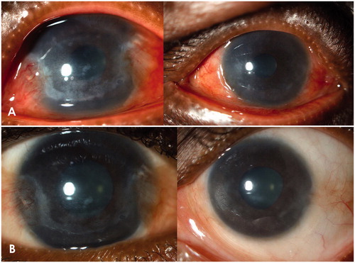 Figure 1. (A) both eyes before treatment. (B) both eyes 3 months after local treatment with amphotericin B.