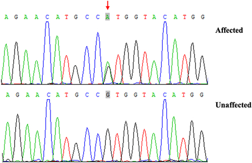 Figure 2 Sanger sequencing chromatograms of proband (patient with PP, affected) and normal control (unaffected) at the c.64 G>A mutation site indicated by arrow (NM_000431: exon2:c.G64A:p.V22M).