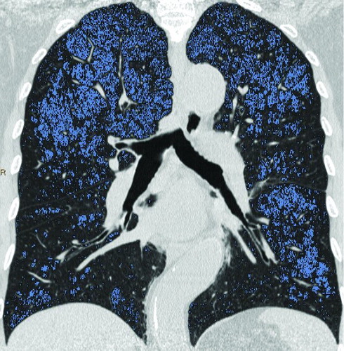 Figure 4.  A 72-year-old man with “moderate COPD” (smoking index 20 pack-years, FEV1/FVC%, 56.2%; % FEV1, 53.26%). (Fig. 4a) Coronal non-enhanced CT shows normal lung as gray scale and diffuse emphysema (threshold lower than −950HU) as blue, both upper-middle fields predominant distribution. (Figures 4b, 4c) Coronal perfusion image acquired with DCE-MRI shows diffuse patchy perfusion defects in both lungs. And the distribution of emphysema was accordance with the PDs.