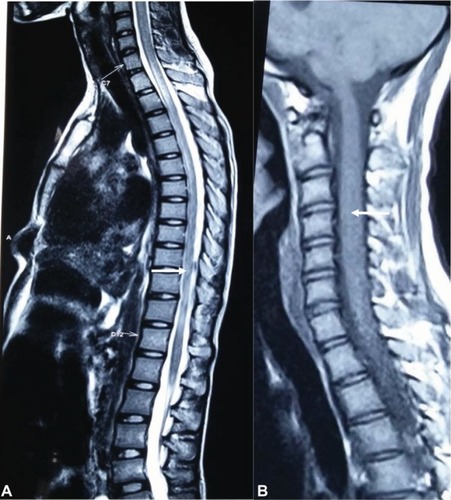 Figure 4 Longitudinal myelitis extending caudally upto L1 and rostrally upto pons. T2 weighted image (A); T1 weighted image (B). The white arrows show white matter hyperintensities.