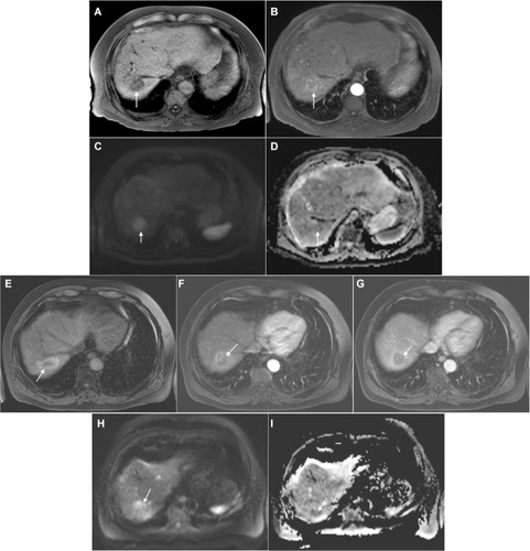 Figure 9 A 69-year-old male with a history of bladder cancer, alcoholic cirrhosis, and HCC.