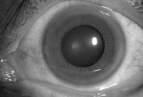 Figure 2 Resolution of band keratopathy with elimination of intraocular inflammation and normalization of serum calcium.