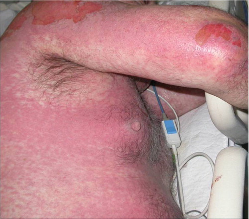 Figure 2. Confluent purpuric macules and limited areas of skin detachment in Stevens–Johnson syndrome.