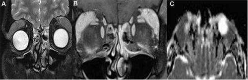 Figure 5 MRI of Extranodal Marginal Zone Lymphoma (A) Coronal fat saturated and post contrast (B) Fat suppressed T1 with contrast and apparent diffusion coefficient images (C) Diffusion Weight Image showing restricted pattern (mean 0.85 X 10_3).