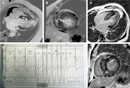 Figure 1 Representative LGE and non-sustained ventricular tachycardia image from patients. (A, B) The 4-chamber long-axis and left ventricular short-axis image from a patient who have severe OSA with a value of 13.99%LGE (arrow); (C) the representative non-sustained ventricular tachycardia image from the same patient; (D–E) the 4-chamber long-axis and left ventricular short-axis image from a patient who have severe OSA with a value of 21.88%LGE (arrow).