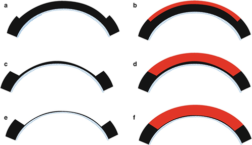 Figure 5 Schematic representation of the anterior lamellar keratoplasty technique with varying depths of recipient cornea removal and donor corneal transplantation. (a and b) One-third of the anterior cornea is removed and replaced with a similarly sized donor cornea. (c and d) Larger amount of anterior cornea is removed and replaced. (e and f) Deep anterior lamellar keratoplasty where corneal tissue is removed up to the bare Descemet membrane and donor cornea without Descemet membrane is transplanted.