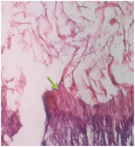 Figure 4. A photomicrograph of dental pulp under bio sponge capping materials: showing moderate hard tissue deposition beneath the capping material with no inflammatory response. The green arrow indicates the formed tissue. (400x).