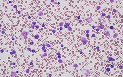 Figure 1 Blood film demonstrates normocytic anaemia, moderate thrombocytopenia hyperleukocytosis with large lymphoma cells.