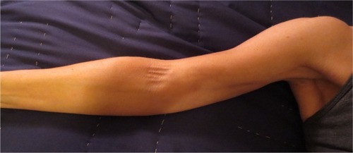 Figure 2 Axillary web syndrome of the right extremity.