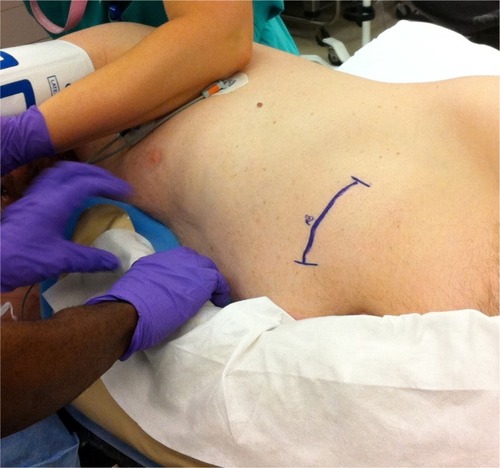 Figure 5 Patient in the lateral decubitus position for implantation of intrathecal drug delivery system. The blue surgical mark indicates anticipated incision in the left lower quadrant for the pump reservoir pocket. Note the importance of cushioning in this position to avoid complications associated with intraoperative nerve compression injuries. Photograph courtesy of MMB.