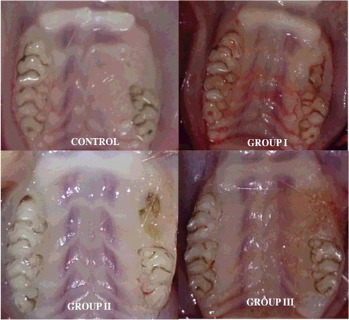Figure 1. Clinical appearance of extraction sites: control group; complete mucosal healing, Group I; osteonecrosis with swelling and hyperaemia, Group II; osteonecrosis, Group III; complete mucosal healing.