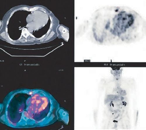 Figure 2. Patient from Figure 1 two months after treatment. Clear PET/CT scan showing complete resolution.