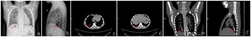 Figure 3. (a, b) Chest anteroposterior and lateral radiographs showing a needle-shaped metallic foreign body aligned with the bronchial path; (c, d) Transverse sections revealing a short rod-shaped dense shadow; (e, f) Tracheobronchial reconstruction images showing a slender rod-shaped metallic dense shadow within the right lower lobe basal segmental bronchus.