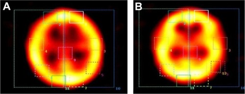 Figure 1 Comparison between baseline (A) and post-retrieval (B) activation of brain region in a subject after total sleep deprivation.