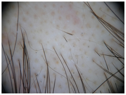 Figure 1 Alopecia areata: yellow dots and exclamation mark hairs.