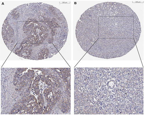 Figure 2 Immunohistochemical staining of TCHH in gastric cancer. The TCHH was high (A) and low (B) expressed in gastric cancer.