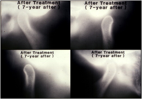 Figure 9. Radiographic images of TMJs at the 7-year follow-up. The right TMJ at ICP (top-left) and at jaw open position (top-right). The left condyle at ICP (bottom-right) and at jaw open position (bottom-left). Both condyles traveled enough anteriorly during jaw opening.