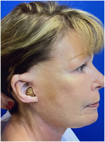 Figure 5. Results of procedure in lateral view two weeks after completion of stage 2 (flap inset).