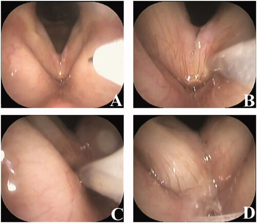 Figure 1. Vocal fold steroid injection procedure. Three micrograms of triamcinolone acetonide dissolved in 0.3 ml of solution are injected into the superficial lamina propria using a 23-gauge injection needle. (A) Before vocal fold injection. (B) Injection of the left vocal fold. (C) Injection of the right vocal fold. (D) After vocal fold injection.