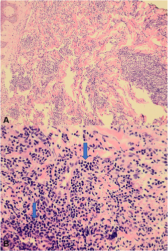 Figure 2 (A) (200×) The superficial and deep dermis show patchy dense lymphoid infiltrate. (B) (400×) The dermal infiltrate consists of large lymphoid cells (arrows) with round to oval abnormal nuclei surrounded by small mature lymphocytes in excess.