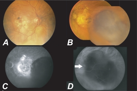 Figure 1 A) Color fundus picture of the right eye of our patient showing a macular scar. B) Color-mosaic fundus picture of the left eye (LE) before treatment showing a macular scar and a large hemorrhagic pigment epithelial detachment (PED) temporal to the fovea resembling a choroidal melanoma. C) Late phase of fluorescein angiography of the LE showing hyperfluorescence due to staining of fibrotic tissue at the fovea and hypofluorescence due to masking of the hemorrhagic PED temporal to the fovea. D) Mid phase of Indocyanine green angiography showing hypofluorescence due to the PED with two hot spots at the margins (white arrows).
