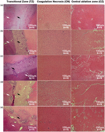 Figure 3. Microscopic appearance of the three ablation sub-zones in vivo rabbit livers, 14 days after radiofrequency ablation (RFA) at 103 °C and 30 W for 3 min, by perfusion group. (a) Normal saline control, (b) 5% HCl, (c) 10% HCl, (d) 15% HCl, and (e) 20% HCl. Transition zone (TZ): fibrous tissue and infiltrates of inflammatory cells (black arrow), adjacent to normal liver parenchyma (white arrow) (hematoxylin–eosin, original magnification 40×); coagulation necrosis zone (CN): necrosis, maintenance of normal structures as “ghost cells”, and small infiltrates of inflammatory cells (hematoxylin–eosin, original magnification 100×); central zone (CZ): hepatic lobules and cytoarchitecture preserved in saline-RFA control group but damaged in all HCl-RFA groups with necrosis and fragments of hepatocytes (hematoxylin–eosin, original magnification 100×).